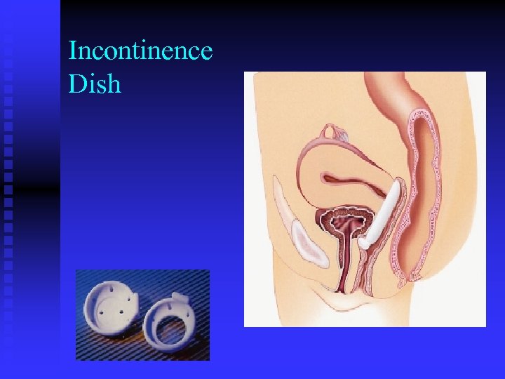 Incontinence Dish 