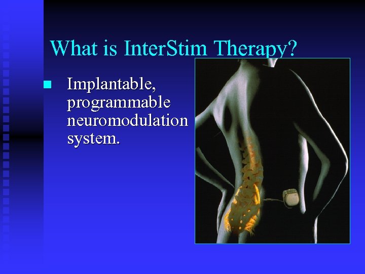 What is Inter. Stim Therapy? n Implantable, programmable neuromodulation system. 