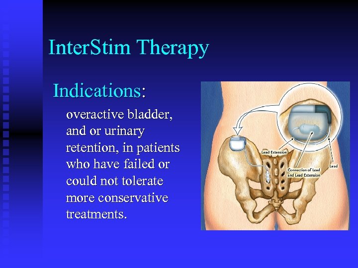 Inter. Stim Therapy Indications: overactive bladder, and or urinary retention, in patients who have