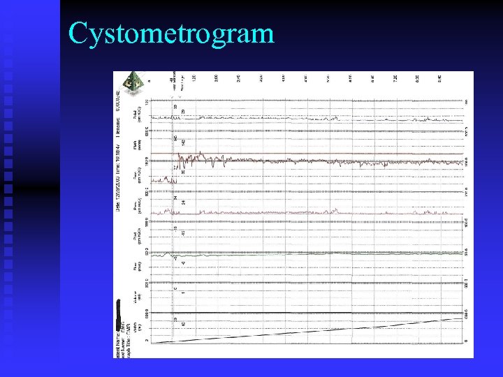 Cystometrogram 