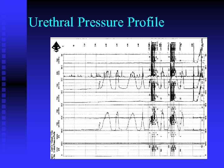 Urethral Pressure Profile 