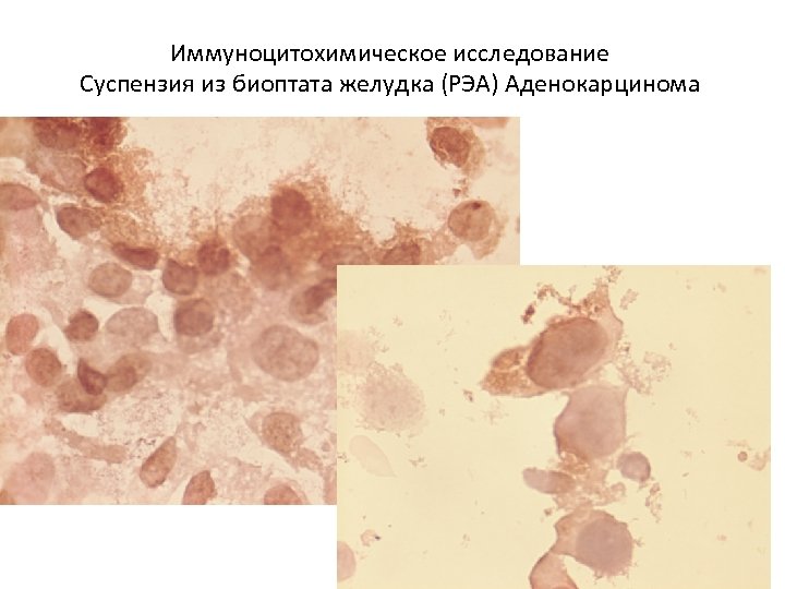 Иммуноцитохимическое исследование Суспензия из биоптата желудка (РЭА) Аденокарцинома 