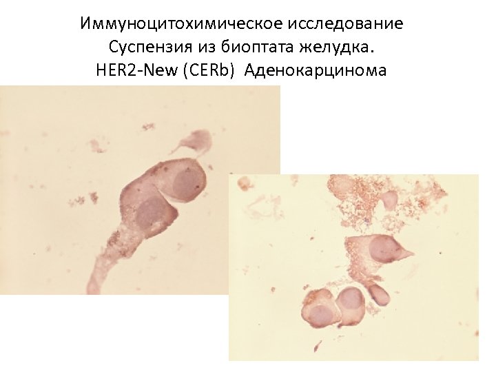 Иммуноцитохимическое исследование Суспензия из биоптата желудка. HER 2 -New (CERb) Аденокарцинома 