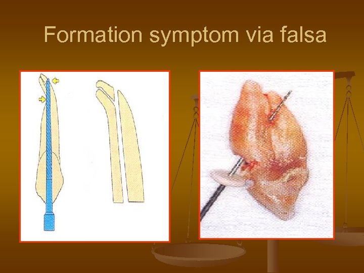 Formation symptom via falsa 