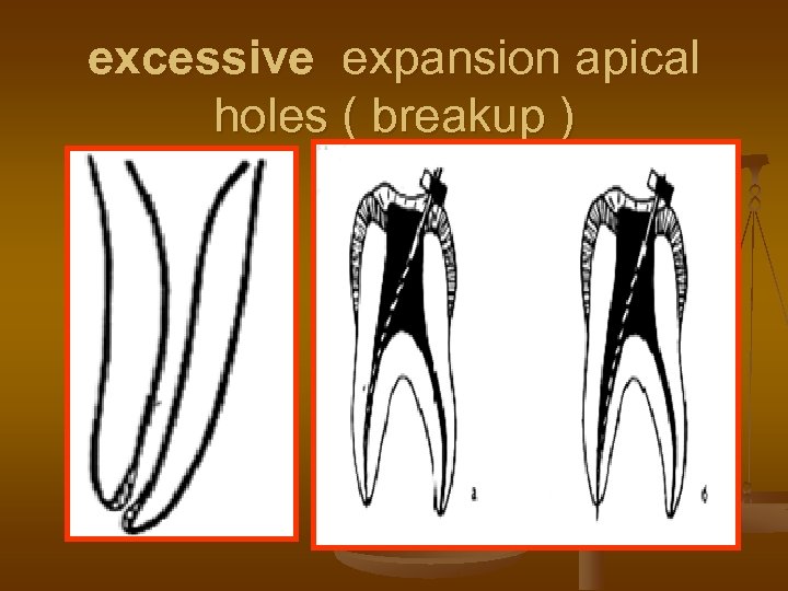 excessive expansion apical holes ( breakup ) 