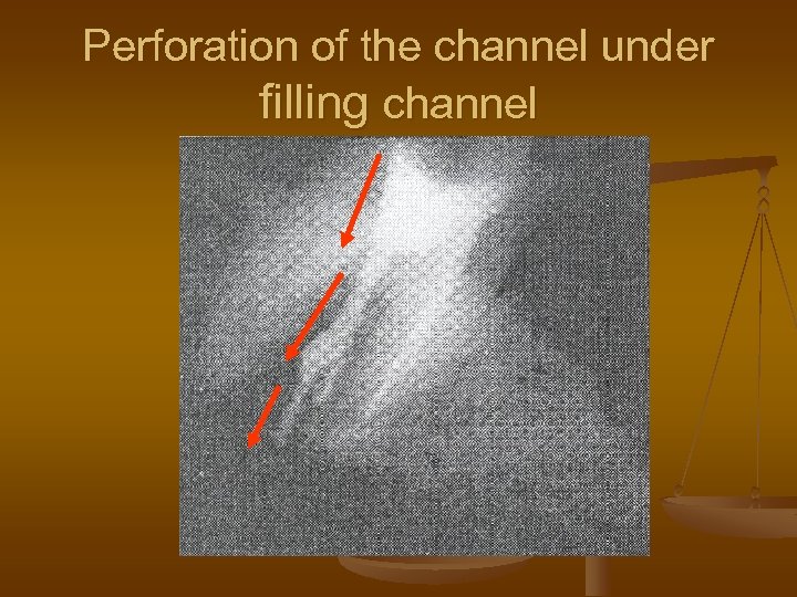 Perforation of the channel under filling channel 