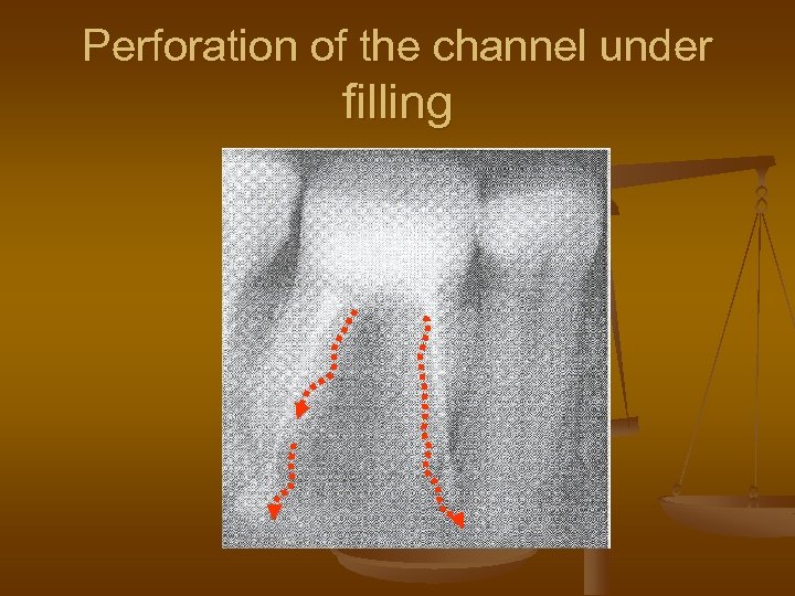 Perforation of the channel under filling 