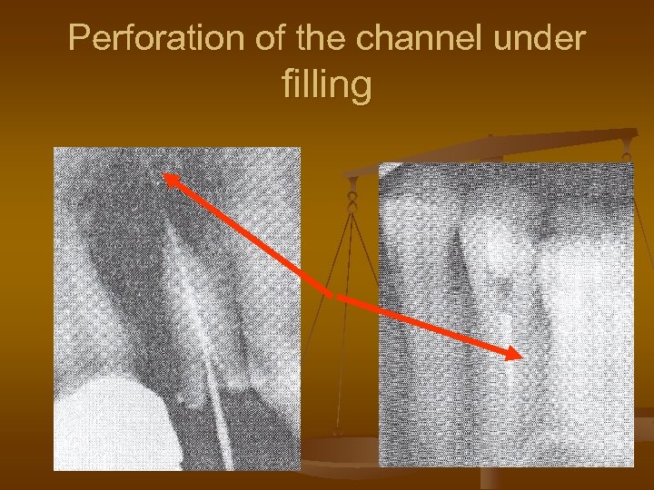 Perforation of the channel under filling 