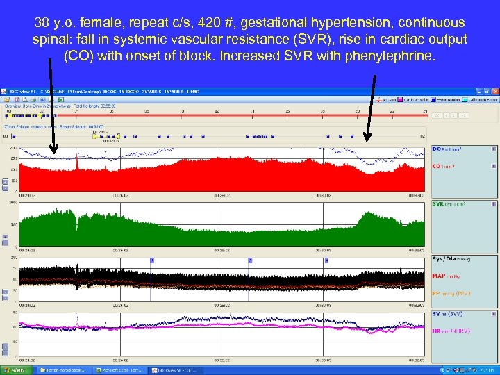 38 y. o. female, repeat c/s, 420 #, gestational hypertension, continuous spinal: fall in