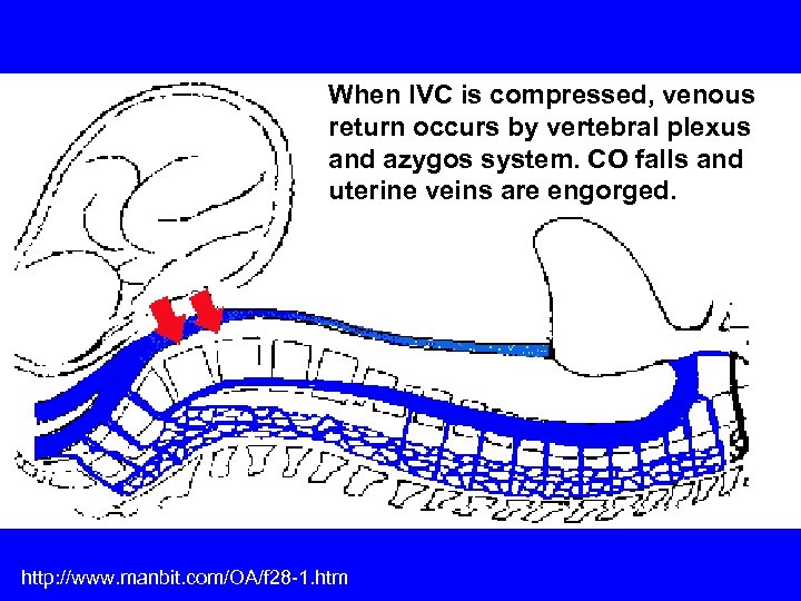 When IVC is compressed, venous return occurs by vertebral plexus and azygos system. CO