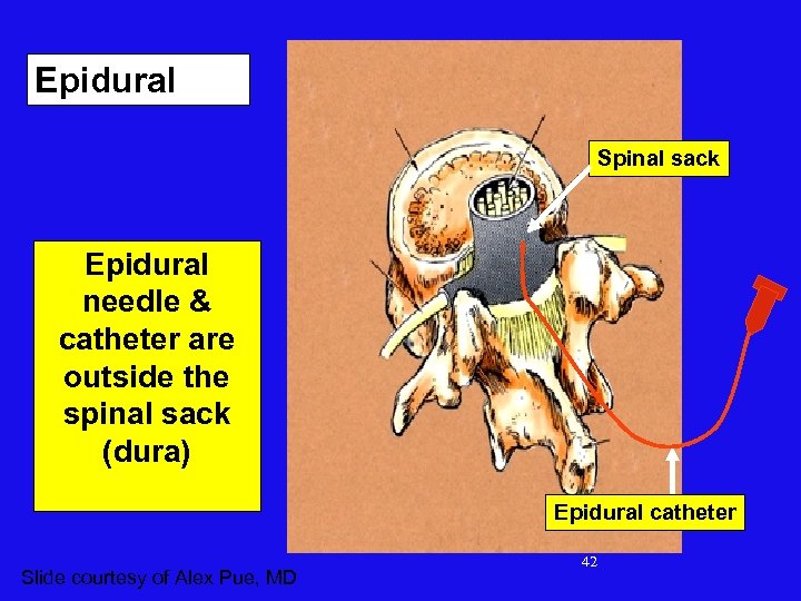 Epidural Spinal sack Epidural needle & catheter are outside the spinal sack (dura) Epidural