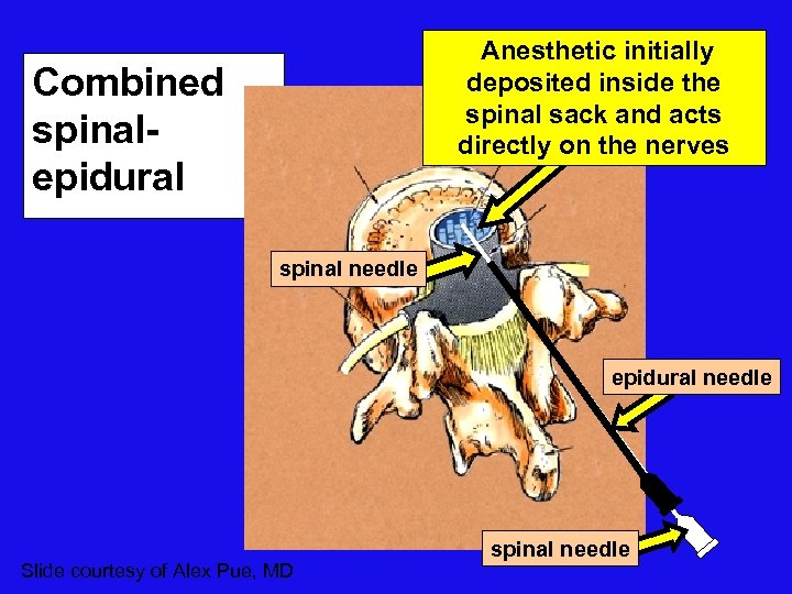 Anesthetic initially deposited inside the spinal sack and acts directly on the nerves Combined
