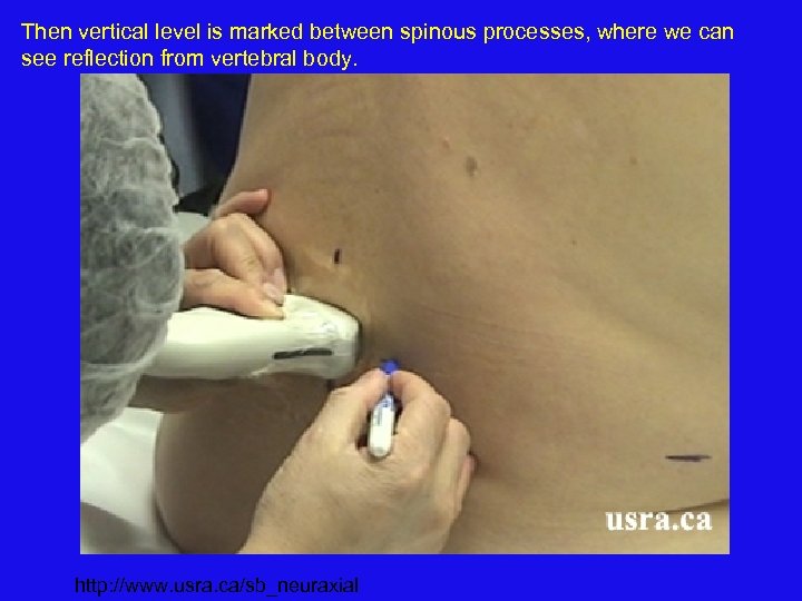 Then vertical level is marked between spinous processes, where we can see reflection from