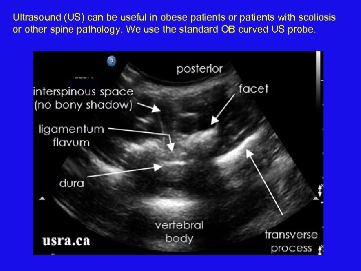 Ultrasound (US) can be useful in obese patients or patients with scoliosis or other