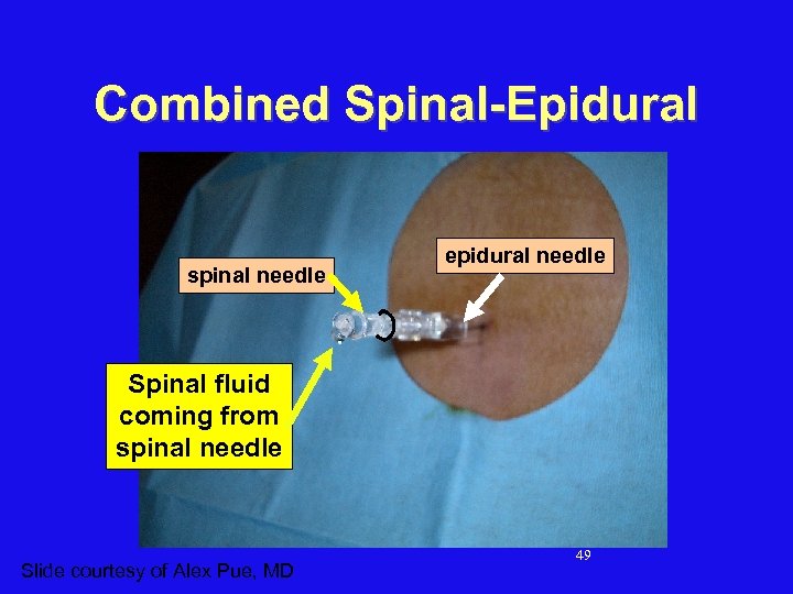 Combined Spinal-Epidural spinal needle epidural needle Spinal fluid coming from spinal needle Slide courtesy
