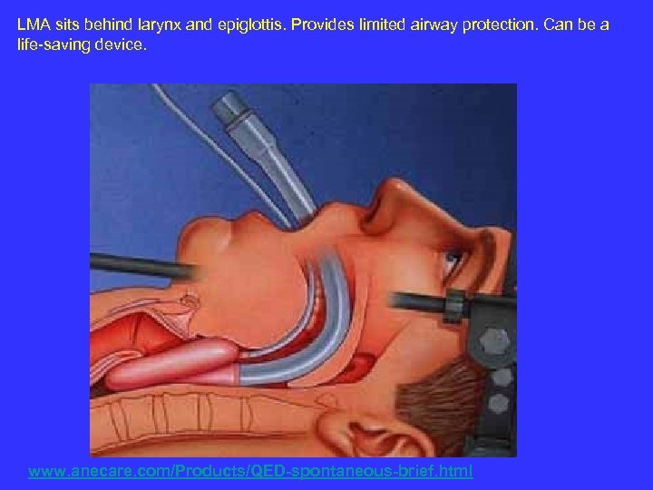 LMA sits behind larynx and epiglottis. Provides limited airway protection. Can be a life-saving
