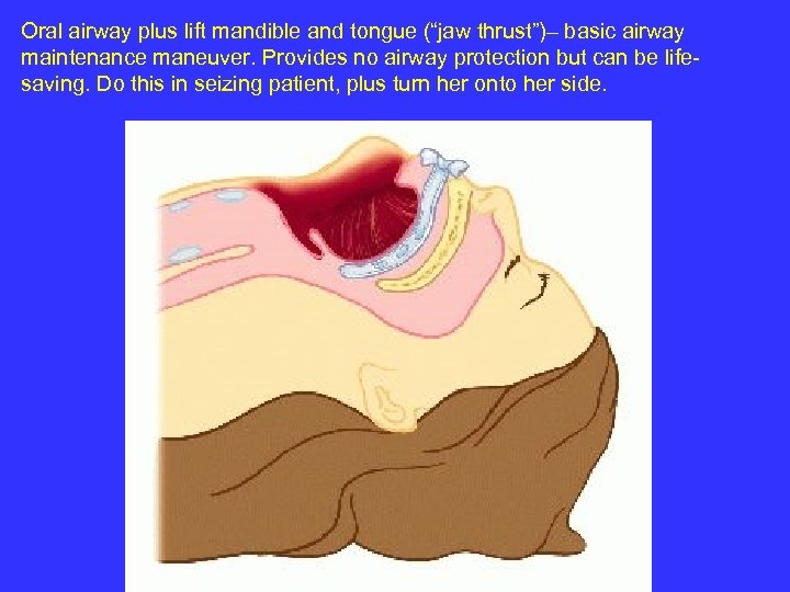 Oral airway plus lift mandible and tongue (“jaw thrust”)– basic airway maintenance maneuver. Provides