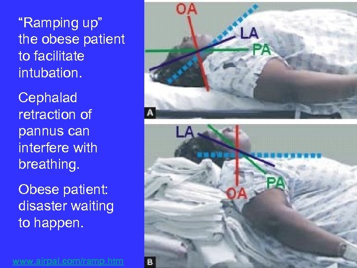 “Ramping up” the obese patient to facilitate intubation. Cephalad retraction of pannus can interfere