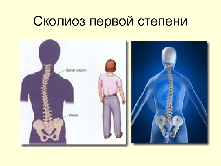 Сколиоз по степеням с картинками