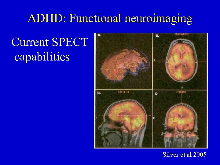 ADHD: Functional neuroimaging Current SPECT capabilities Silver et al 2005 
