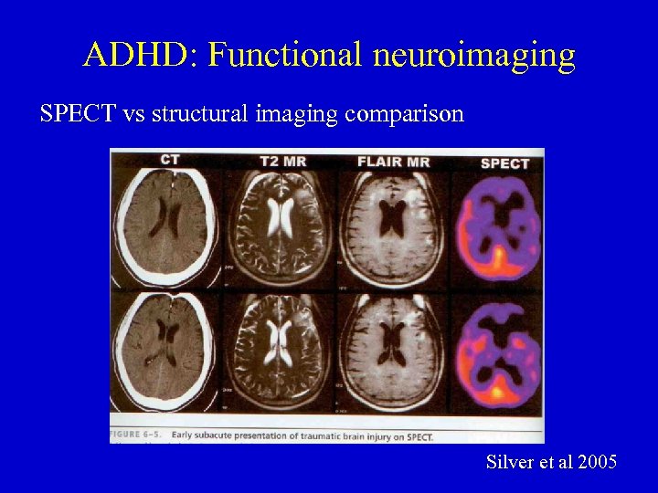 ADHD: Functional neuroimaging SPECT vs structural imaging comparison Silver et al 2005 