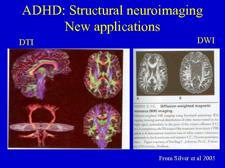 ADHD: Structural neuroimaging New applications DTI DWI From Silver et al 2005 