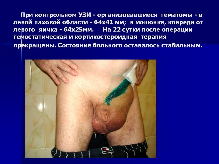 При контрольном УЗИ - организовавшиеся гематомы - в левой паховой области - 64 х41