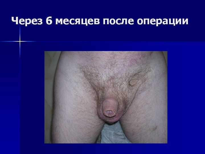 Через 6 месяцев после операции 