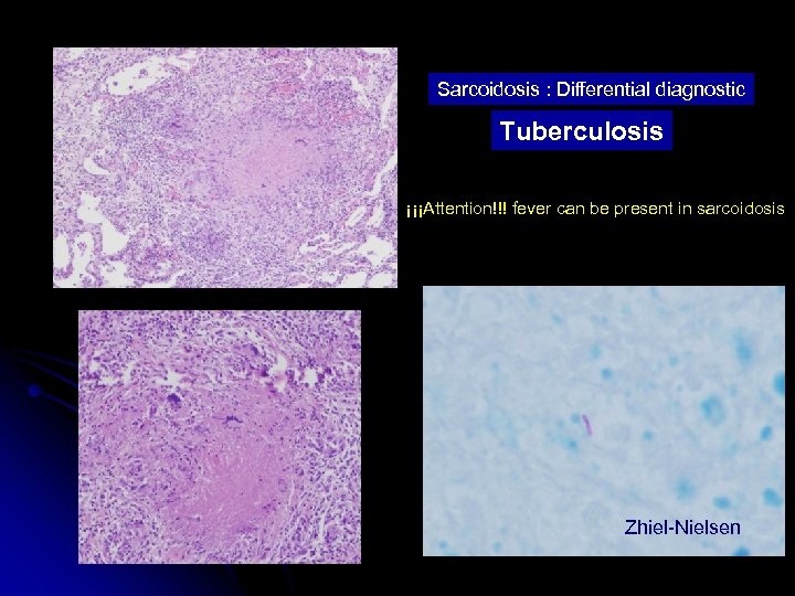 Sarcoidosis : Differential diagnostic Tuberculosis ¡¡¡Attention!!! fever can be present in sarcoidosis Zhiel-Nielsen 