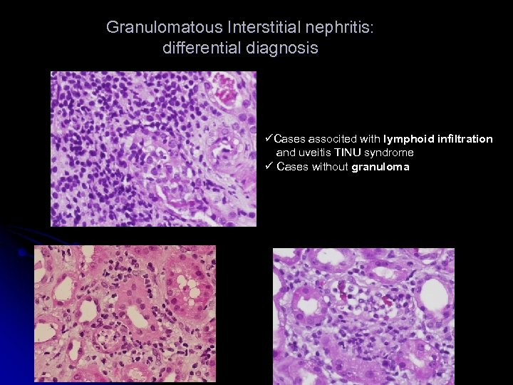 Granulomatous Interstitial nephritis: differential diagnosis üCases associted with lymphoid infiltration and uveitis TINU syndrome