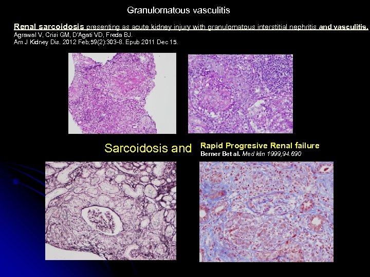Granulomatous vasculitis Renal sarcoidosis presenting as acute kidney injury with granulomatous interstitial nephritis and