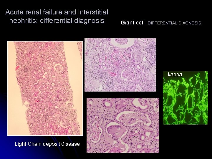 Acute renal failure and Interstitial nephritis: differential diagnosis Giant cell: DIFFERENTIAL DIAGNOSIS kappa Light
