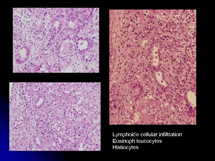 Lymphoide cellular infiltration Eosinoph leucocytes Histiocytes 