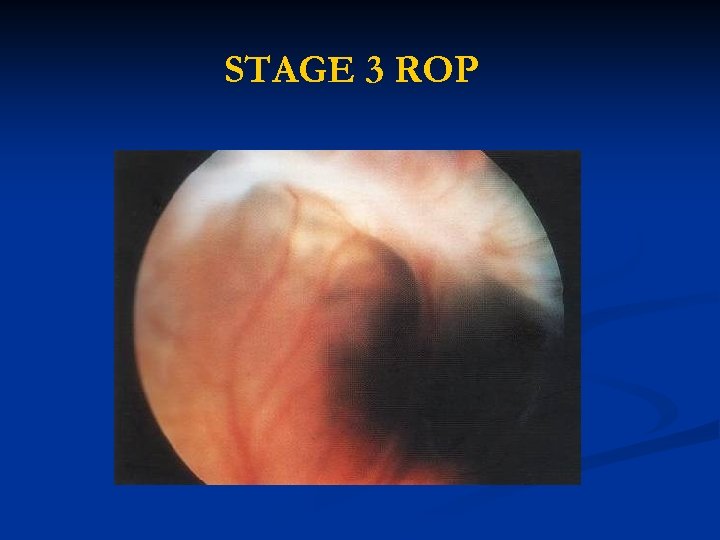 STAGE 3 ROP 