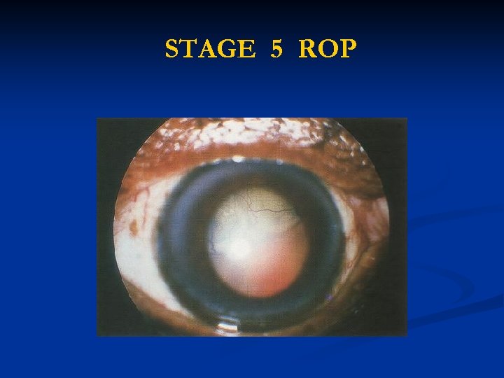 STAGE 5 ROP 