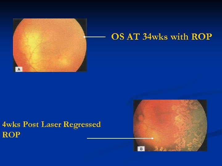 OS AT 34 wks with ROP 4 wks Post Laser Regressed ROP 