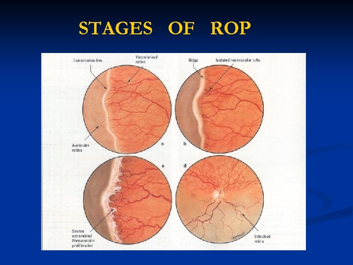 STAGES OF ROP 