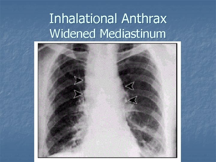 Inhalational Anthrax Widened Mediastinum 