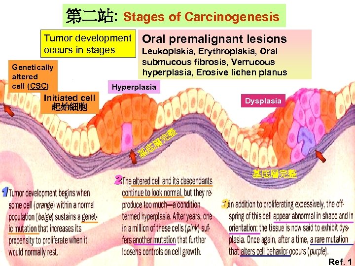 第二站: Stages of Carcinogenesis Tumor development occurs in stages Genetically Gentically altered cell (CSC)