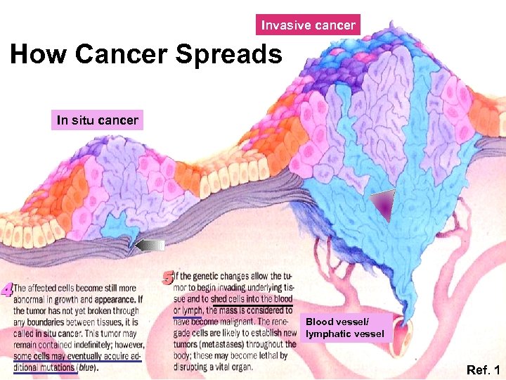 Invasive cancer How Cancer Spreads In situ cancer Blood vessel/ lymphatic vessel Ref. 1