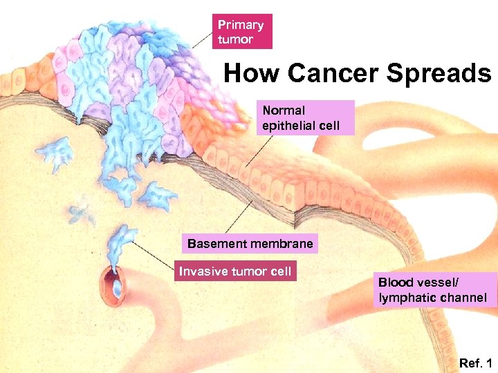 Primary tumor How Cancer Spreads Normal epithelial cell Basement membrane Invasive tumor cell Blood