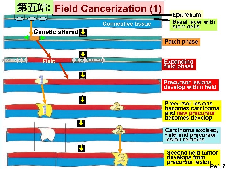 第五站: Field Cancerization (1) Connective tissue Genetic altered Epithelium Basal layer with stem cells