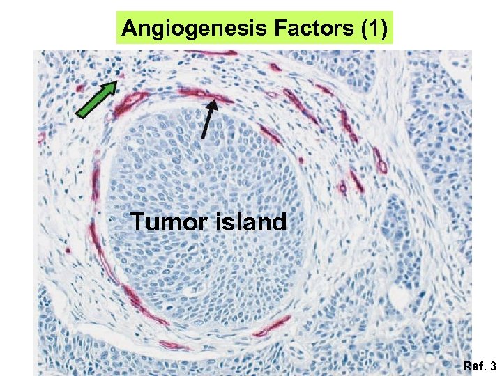 Angiogenesis Factors (1) Tumor island Ref. 3 