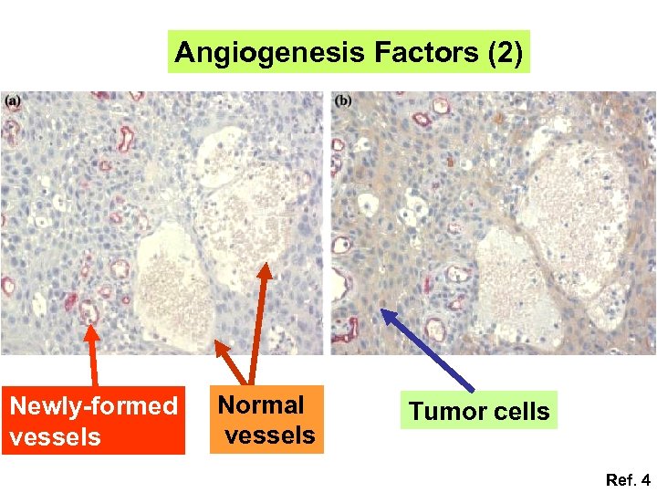 Angiogenesis Factors (2) Newly-formed vessels Normal vessels Tumor cells Ref. 4 