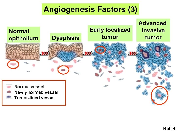 Angiogenesis Factors (3) Normal epithelium Dysplasia Early localized tumor Advanced invasive tumor Normal vessel