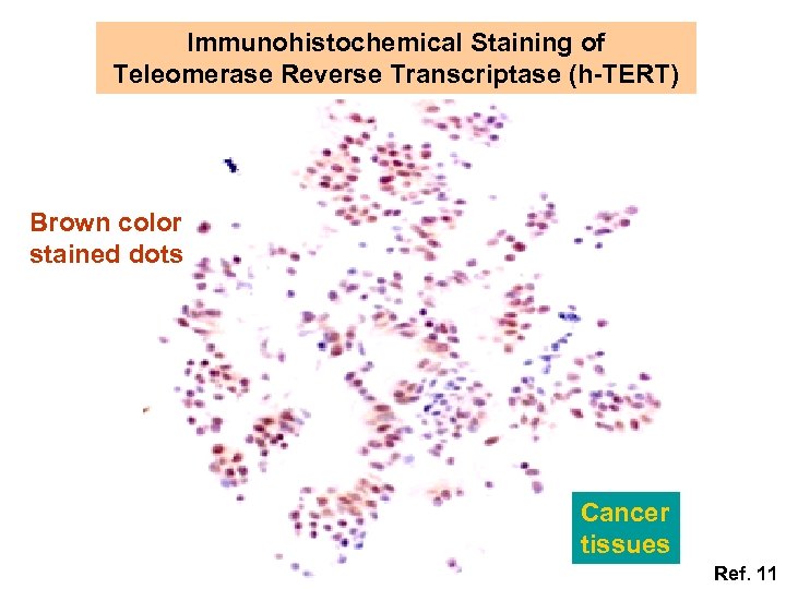 Immunohistochemical Staining of Teleomerase Reverse Transcriptase (h-TERT) Brown color stained dots Cancer tissues Ref.