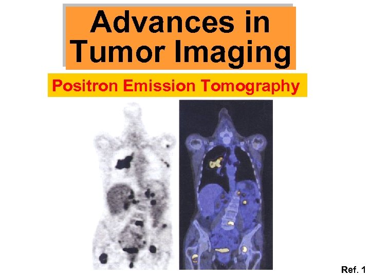 Advances in Tumor Imaging Positron Emission Tomography Ref. 1 