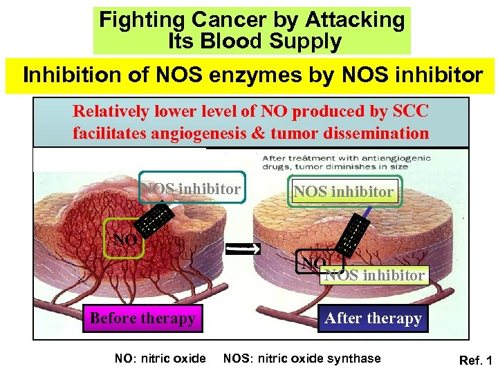 Fighting Cancer by Attacking Its Blood Supply Inhibition of NOS enzymes by NOS inhibitor