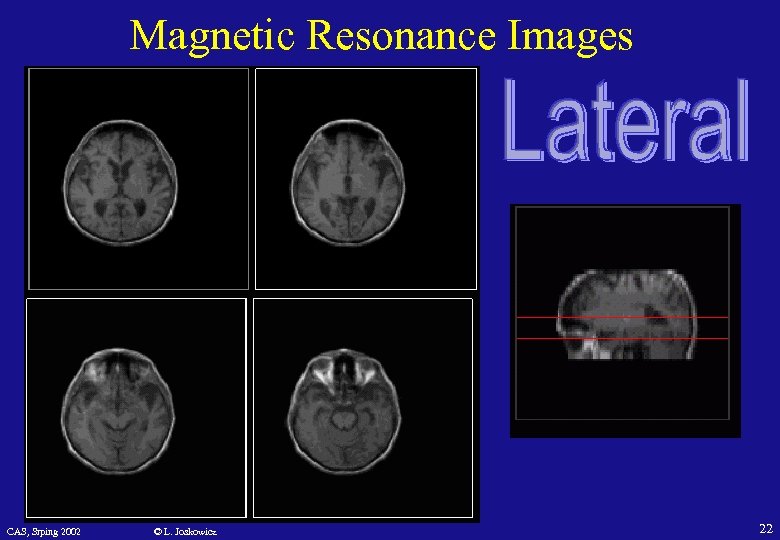 Magnetic Resonance Images CAS, Srping 2002 © L. Joskowicz 22 