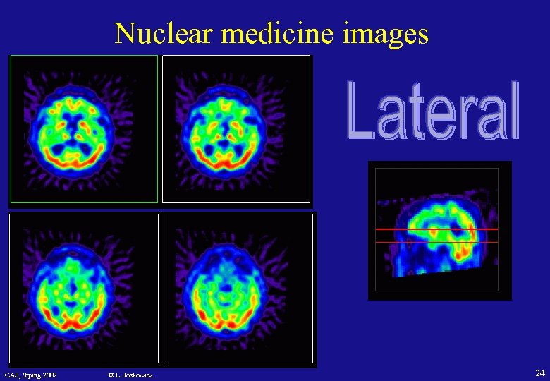 Nuclear medicine images CAS, Srping 2002 © L. Joskowicz 24 